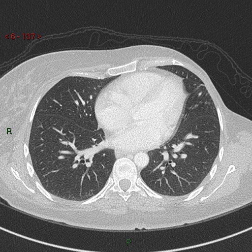 Aortic arch origin of left vertebral artery (Radiopaedia 51520-57286 Axial lung window 137).jpg