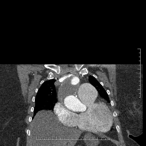 Aortic dissection- Stanford A (Radiopaedia 35729-37268 E 54).jpg