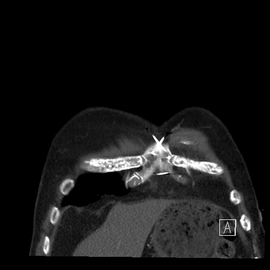File:Aortic dissection (CTPA) (Radiopaedia 75506-86750 B 5).jpg