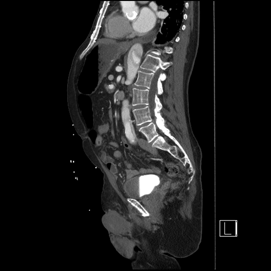 Aortic dissection (CTPA) (Radiopaedia 75506-86750 G 61).jpg