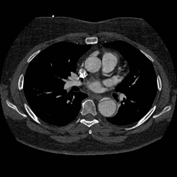 File:Aortic dissection (Radiopaedia 57969-64959 A 154).jpg