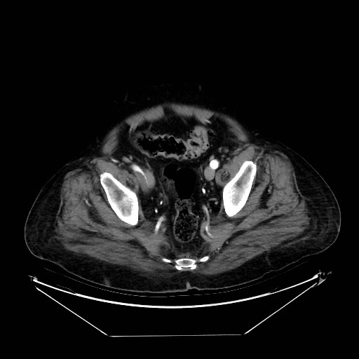 Aortic dissection (Radiopaedia 62562-71000 A 100).jpg