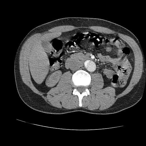 File:Aortic dissection - Stanford A -DeBakey I (Radiopaedia 28339-28587 B 140).jpg