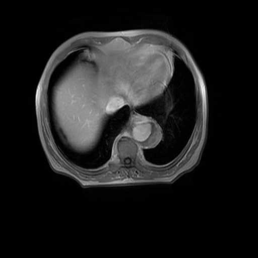 File:Aortic dissection - Stanford A - DeBakey I (Radiopaedia 23469-23551 Axial MRA 30).jpg