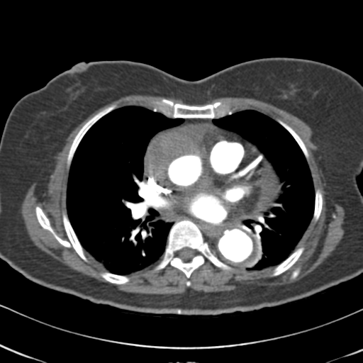 File:Aortic dissection - Stanford type A (Radiopaedia 39073-41259 A 40).png