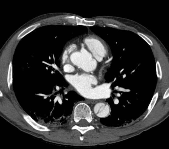Aortic dissection - Stanford type B (Radiopaedia 73648-84437 A 59).jpg