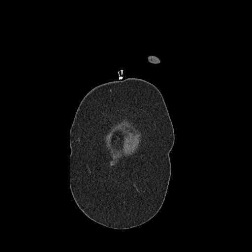 Aortic dissection - Stanford type B (Radiopaedia 88281-104910 B 1).jpg