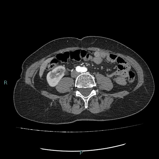 File:Aortic dissection extended to lusory artery (Radiopaedia 43686-47136 B 20).jpg