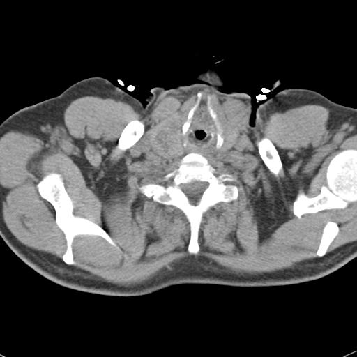 Aortic intramural hematoma (Radiopaedia 31139-31838 Axial non-contrast 2).jpg