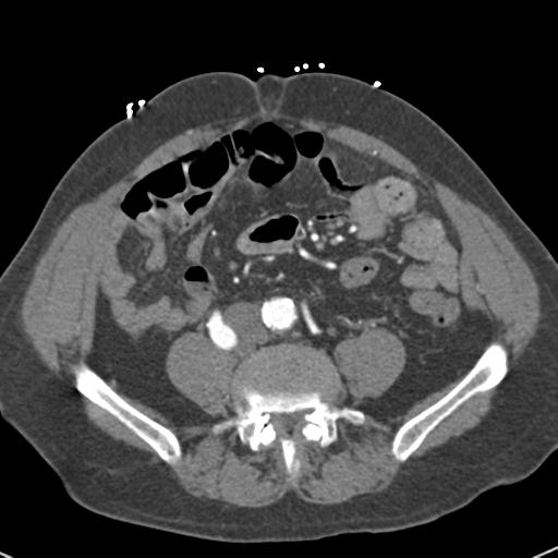 Aortic intramural hematoma (Radiopaedia 31139-31838 B 125).jpg