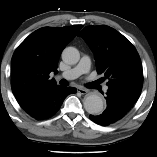 Aortic intramural hematoma (type B) (Radiopaedia 79323-92387 Axial C+ delayed 23).jpg