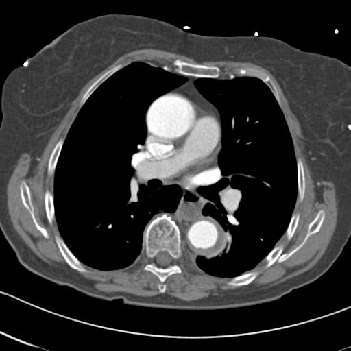 File:Aortic intramural hematoma from penetrating atherosclerotic ulcer (Radiopaedia 31137-31836 A 38).jpg