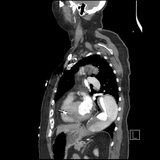 Aortic intramural hematoma with dissection and intramural blood pool (Radiopaedia 77373-89491 D 58).jpg