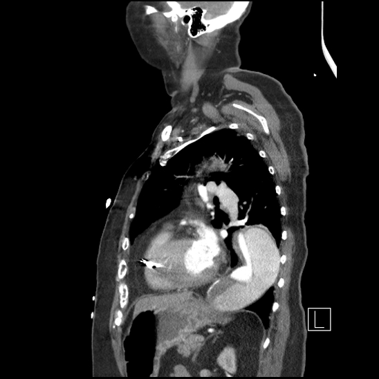 Aortic intramural hematoma with dissection and intramural blood pool (Radiopaedia 77373-89491 D 59).jpg