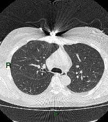File:Aortic valve endocarditis (Radiopaedia 87209-103485 Axial lung window 39).jpg