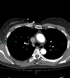 Aortic valve endocarditis (Radiopaedia 87209-103485 C 32).jpg