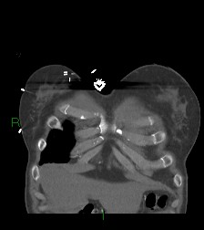 File:Aortic valve endocarditis (Radiopaedia 87209-103485 D 64).jpg