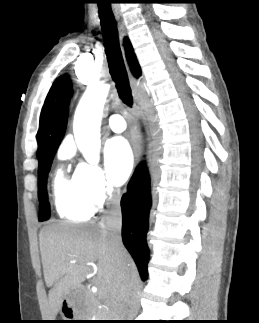 Aortic valve non-coronary cusp thrombus (Radiopaedia 55661-62189 D 29).png