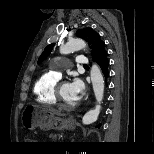 File:Aorto-coronary bypass graft aneurysms (Radiopaedia 40562-43157 C 25).png