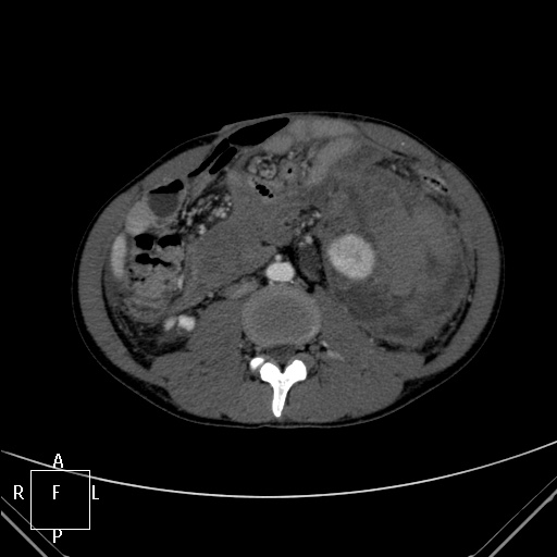 File:Aorto-left renal vein fistula (Radiopaedia 45534-49628 A 37).jpg