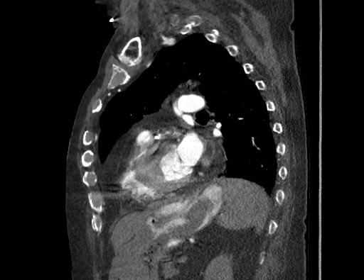 Aortoesophageal fistula with endovascular repair (Radiopaedia 73781-84592 Sagittal C+ CTPA 127).jpg