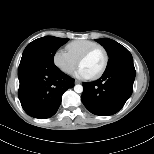 File:Apical pleural calcification (Radiopaedia 46141-50499 Axial C+ delayed 46).png