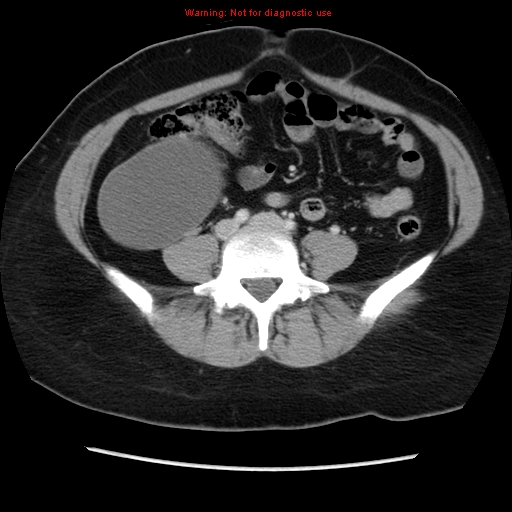 Appendiceal mucinous cystadenoma (Radiopaedia 8263-9111 Axial liver window 53).jpg