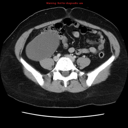 Appendiceal mucinous cystadenoma (Radiopaedia 8263-9111 Axial liver window 55).jpg
