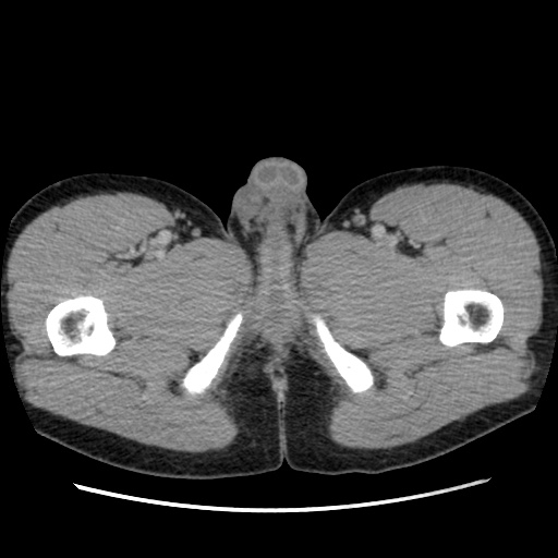 Appendicitis complicated by post-operative collection (Radiopaedia 35595-37114 A 97).jpg