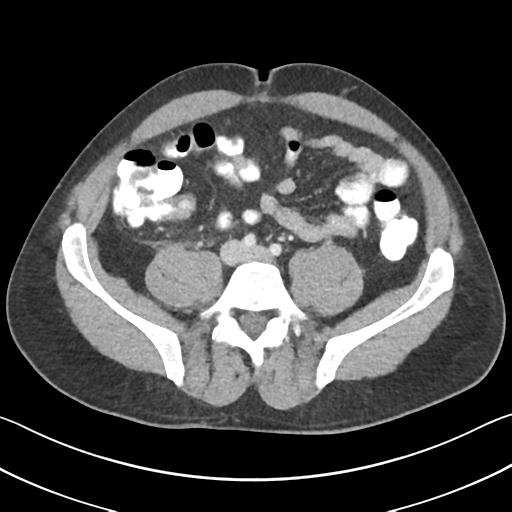 File:Appendicitis with cecal bar sign (Radiopaedia 31878-32830 B 53).jpg