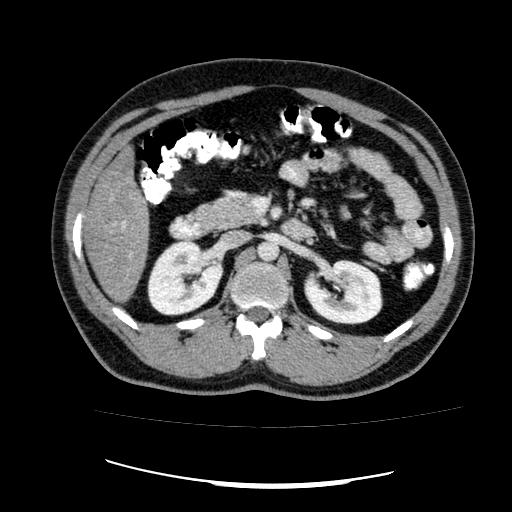 File:Appendicitis with diverticulosis (Radiopaedia 47693-52383 Axial C+ 52).jpg