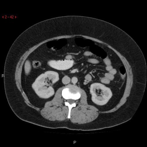 File:Appendicitis with microperforation- promontoric type (Radiopaedia 27268-27442 C 30).jpg