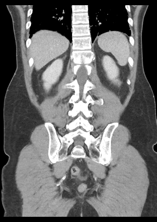 Appendicitis with thickening of the terminal ileum (Radiopaedia 42432-45550 B 45).png