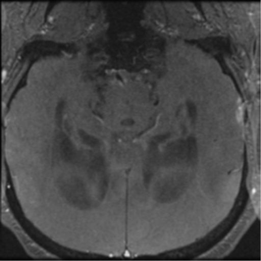 Aqueduct stenosis with corpus callosum hypoattenuation post shunting (Radiopaedia 37212-38969 Axial CSF Flow 36).png