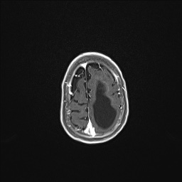 Aqueductal stenosis (Radiopaedia 73974-84802 Axial T1 C+ 130).jpg