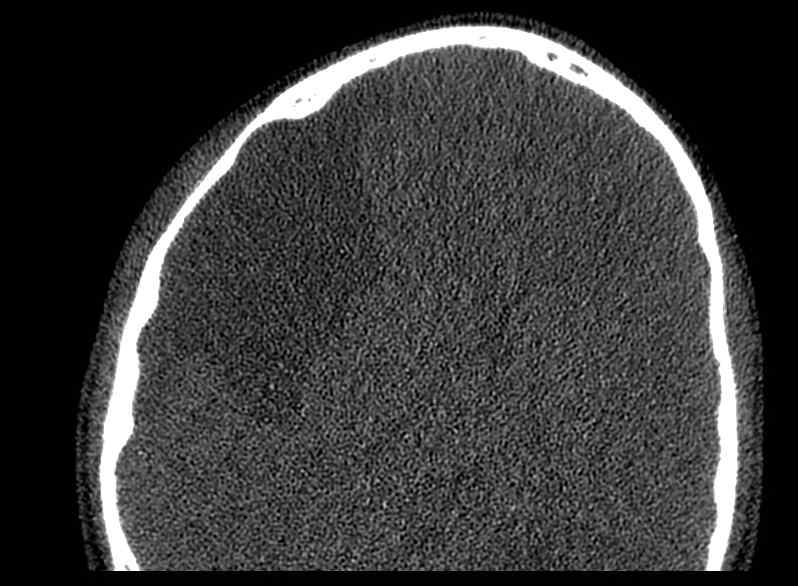 Arachnoid cyst- extremely large (Radiopaedia 68741-78450 Axial bone window 61).jpg