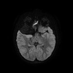 Arachnoid cyst - middle cranial fossa (Radiopaedia 67671-77088 Axial DWI 13).jpg