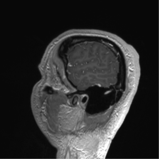 Arachnoid cyst with subdural hematoma (Radiopaedia 85892-101743 Sagittal T1 C+ 81).png
