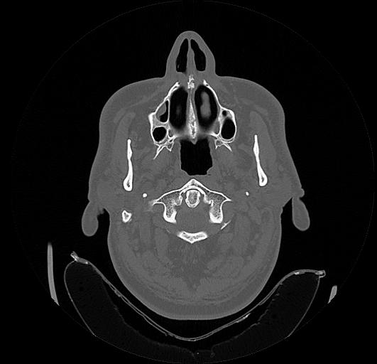 Arcuate foramen (Radiopaedia 89833-106944 Axial bone window 21).jpg