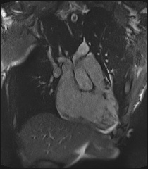 Arrhythmogenic right ventricular cardiomyopathy (Radiopaedia 57972-64966 CINE R2 SSFP 47).jpg