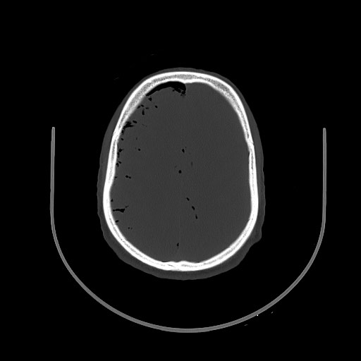 File:Arrow injury to the brain (Radiopaedia 72101-82607 Axial 159).jpg