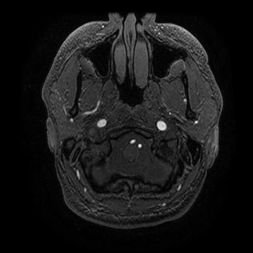 Arteriovenous malformation (Radiopaedia 71628-81999 Axial MRA 36).jpg