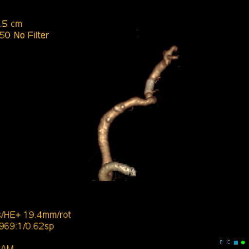 File:Artifactual basilar artery stenosis due to metallic stent (Radiopaedia 31206-31923 C 6).jpg