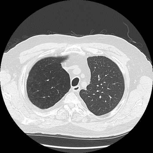 Asbestos-related pleural disease (Radiopaedia 74366-85250 Axial lung window 28).jpg