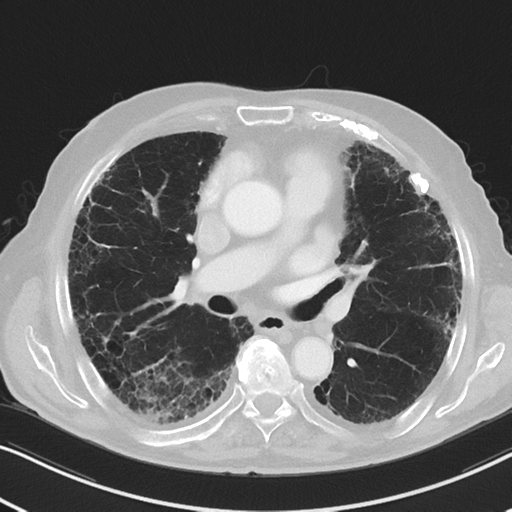 File:Asbestosis (Radiopaedia 56192-62864 Axial lung window 32).png