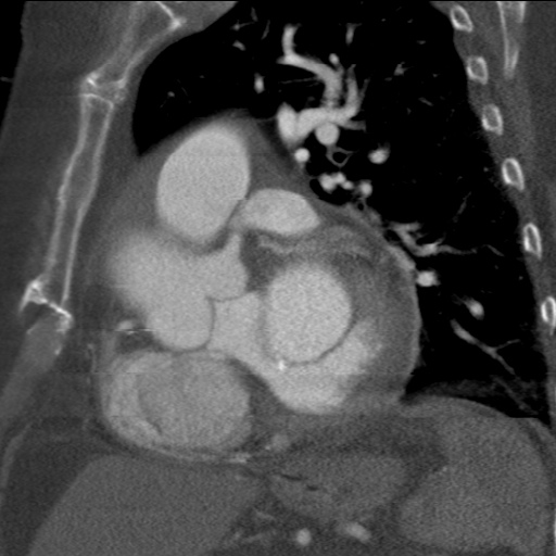 File:Ascending aortic aneurysm (Radiopaedia 20913-20846 A 10).jpg
