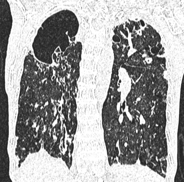 Aspergilloma- with Monod sign (Radiopaedia 44737-48532 Coronal lung window 319).jpg
