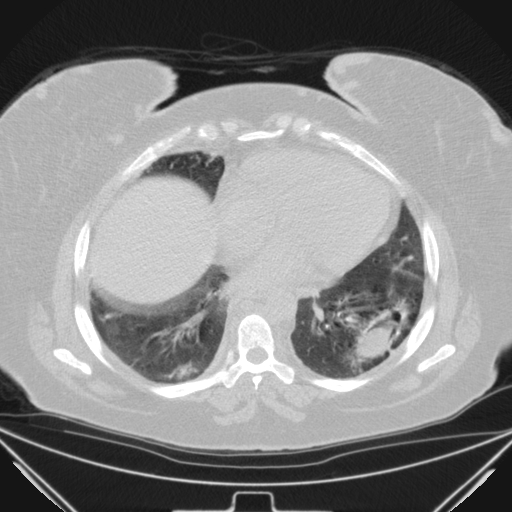 Aspergilloma (Radiopaedia 39611-41932 Axial lung window 87).jpg