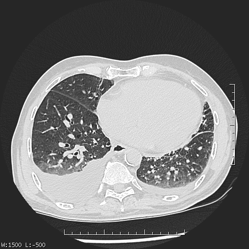 Aspergilloma (Radiopaedia 75184-86270 Axial lung window 37).jpg