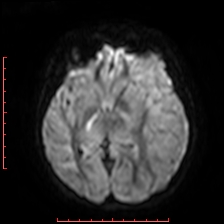 File:Astroblastoma (Radiopaedia 74287-85162 Axial DWI 48).jpg